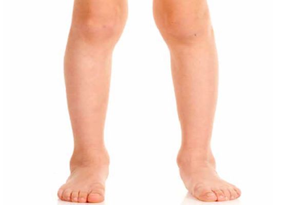 Gene valgum - dziecięca wada kolan